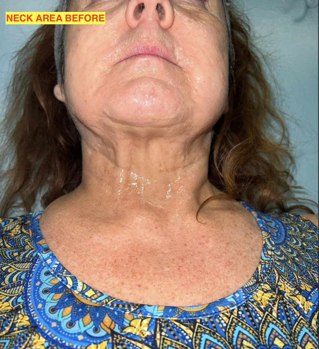 MORPHEUS 8 NECK AREA BEFORE 2