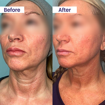 Can Morpheus8 Transform Your Skin (Without Surgery) In a Matter of Weeks?