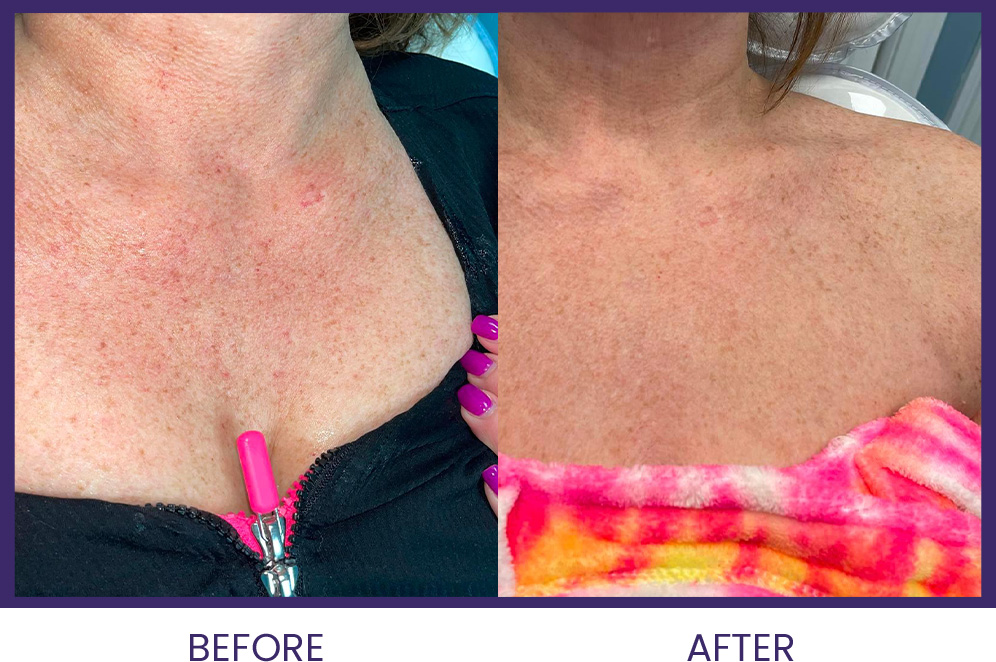 Before and After Photofacial treatment