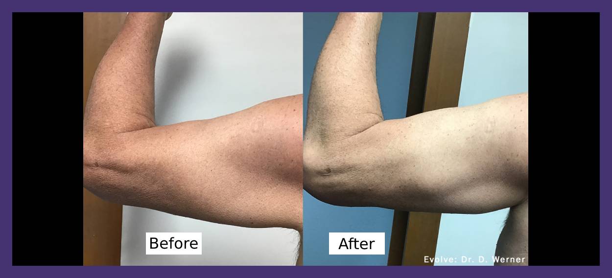 Before and After Tricep