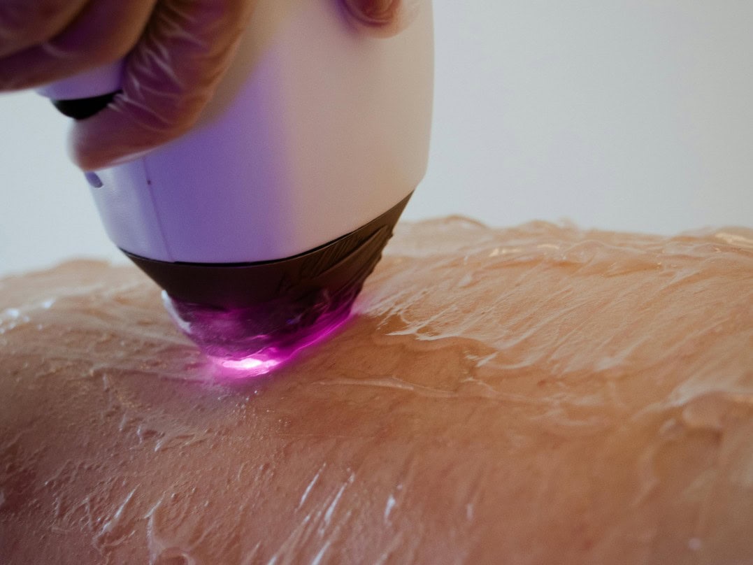 lumecca-ipl-treatment-dartmouth-fall