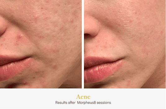 Acne_Before & After