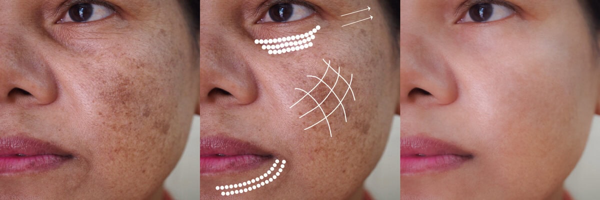 Image before and after anti-aging dark spot melasma pigmentation skin facial treatment and face lift rejuvenation of Asian woman.Problem skincare and health concept.