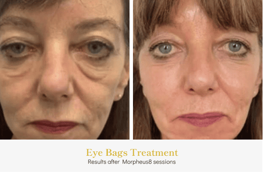 Eye bags_Before & After