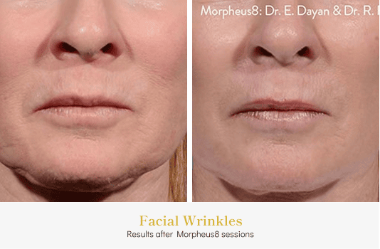 Facial Lines_Before & After