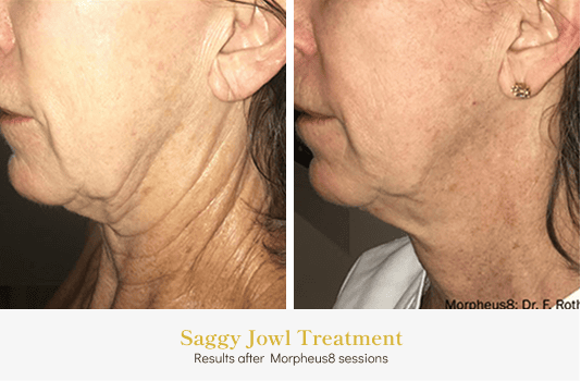 Saggy Jowl_Before & After