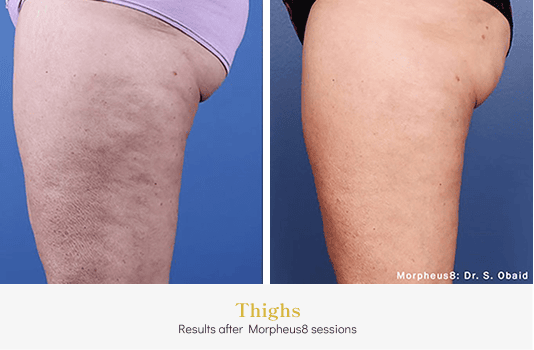 Thighs_Before & After
