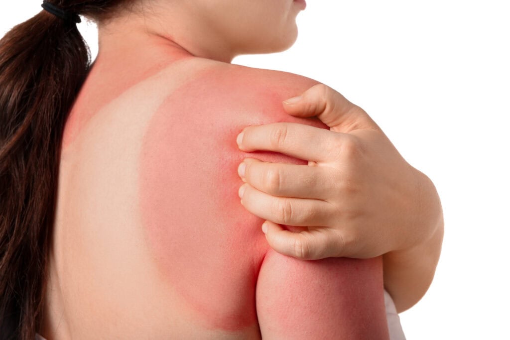 Woman with red sunburned skin against white background, closeup